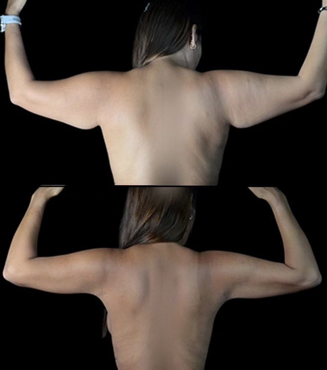 Antes / Después 4
