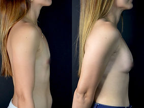 Antes / Después 2
