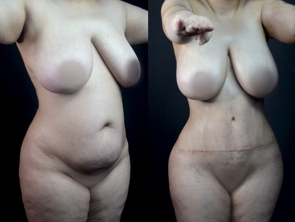 Antes / Después 7