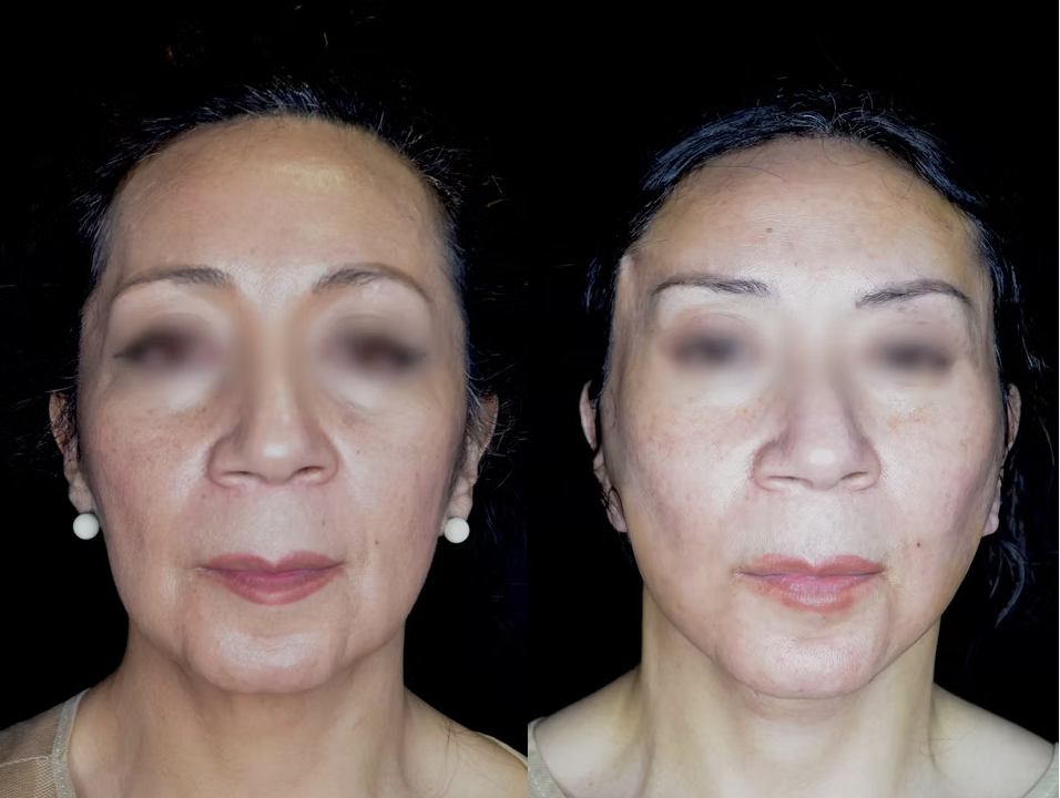 Antes / Después 3
