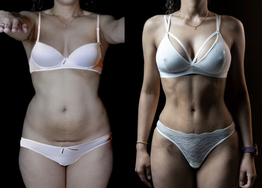 Antes / Después 5
