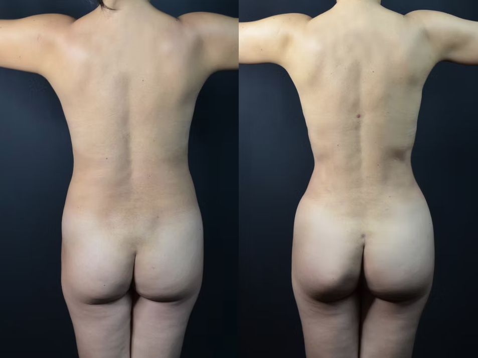 Antes / Después 1