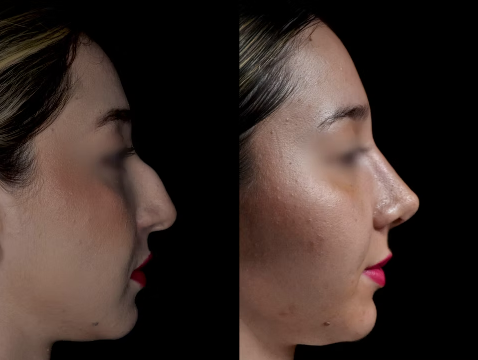 Antes / Después 2