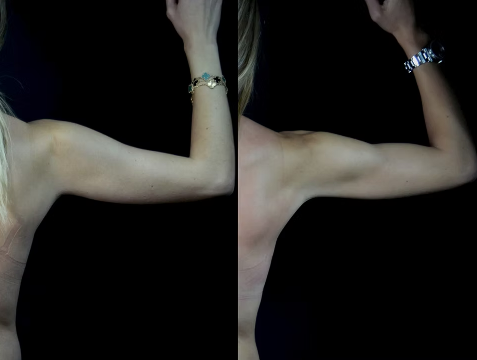 Antes / Después 3