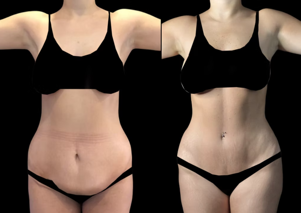 Antes / Después 2