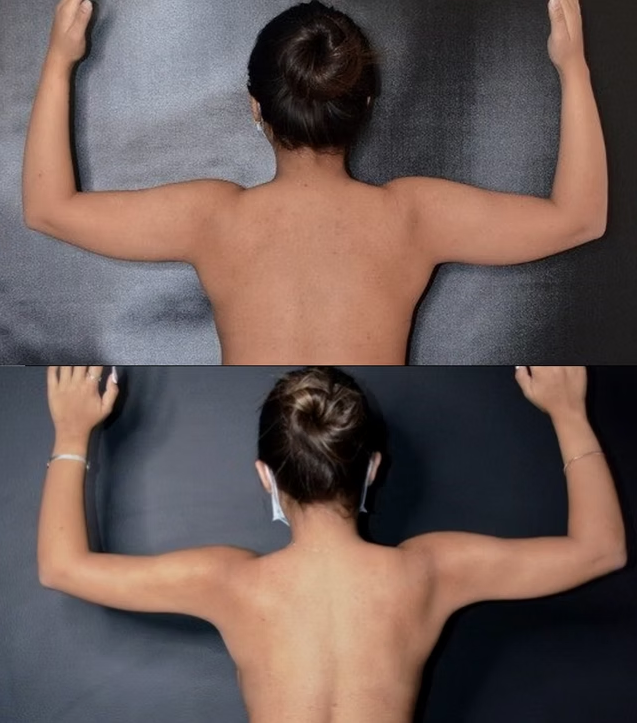 Antes / Después 1