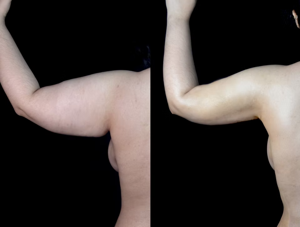 Antes / Después 1