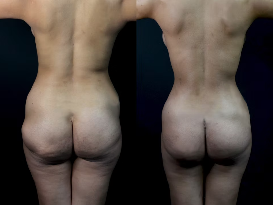 Antes / Después 1