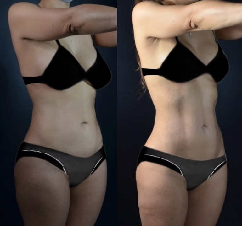 Antes / Después 4