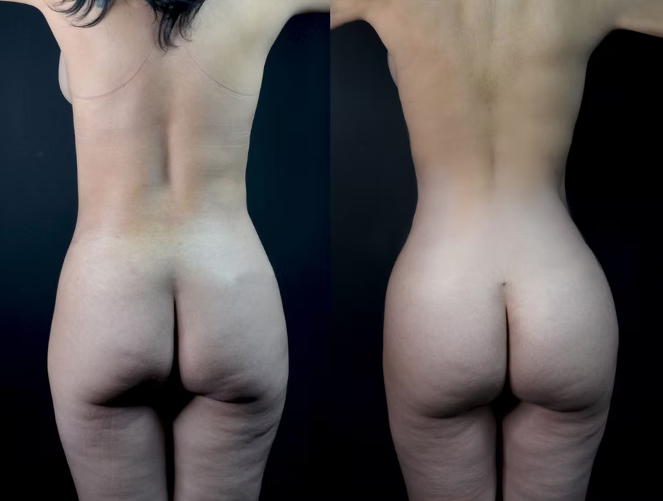 Antes / Después 5