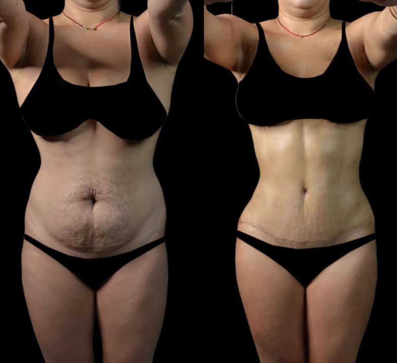 Antes / Después 4