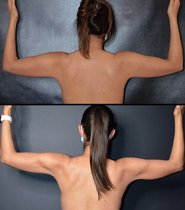 Antes / Después 7