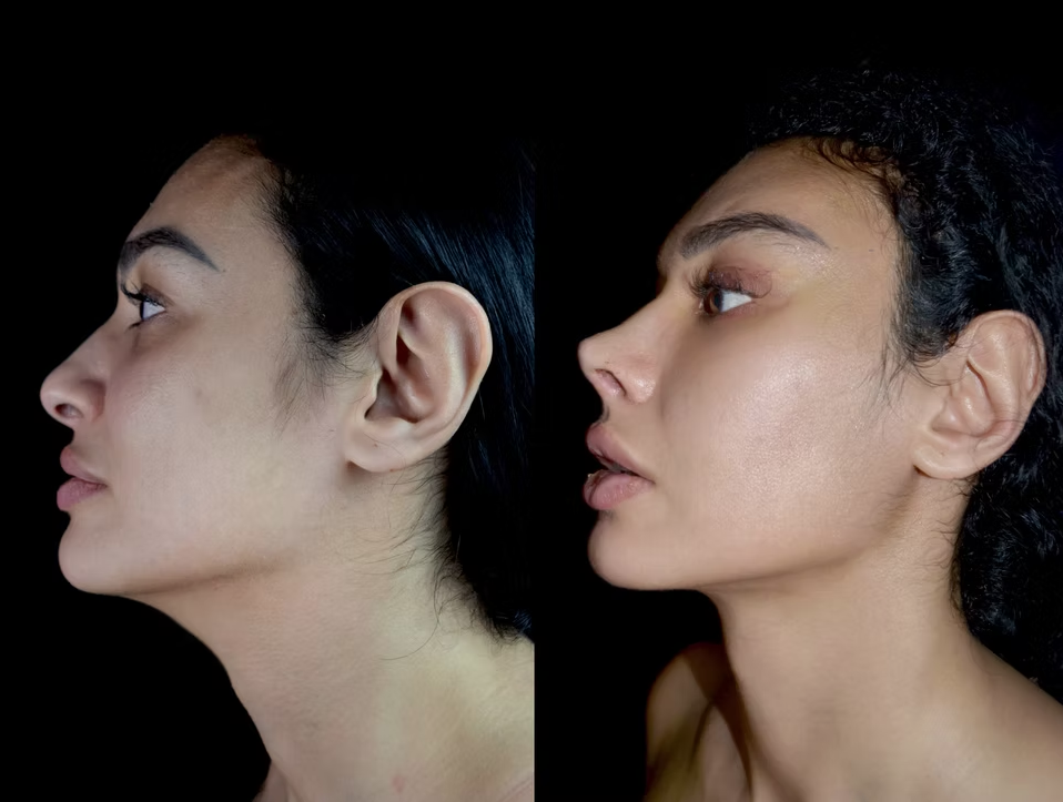 Antes / Después 1