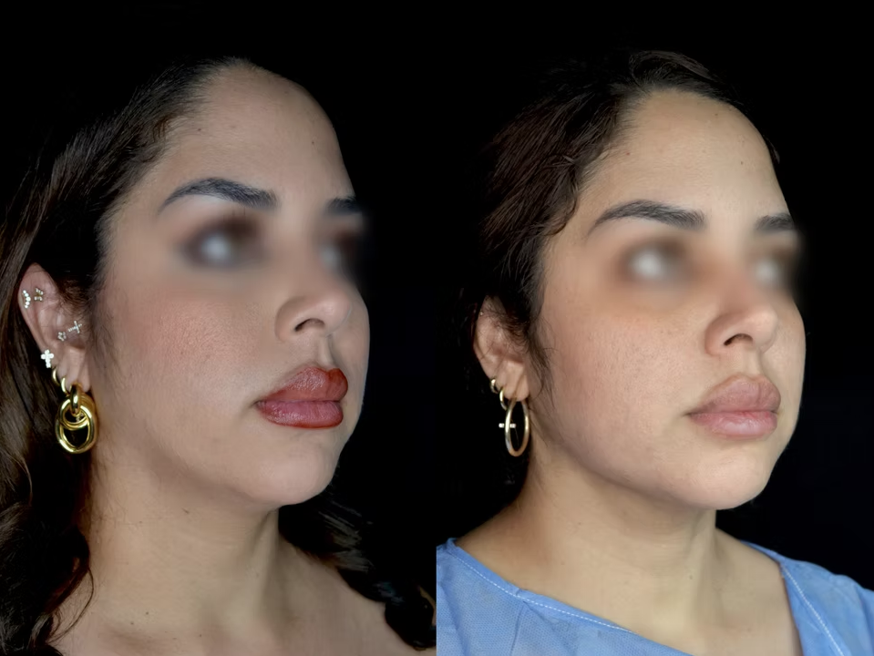 Antes / Después 3