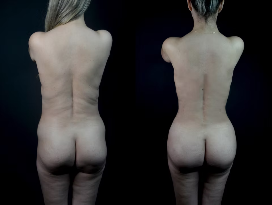 Antes / Después 1