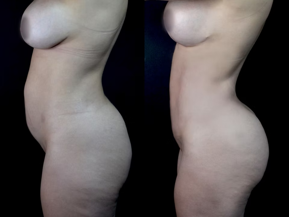 Antes / Después 4