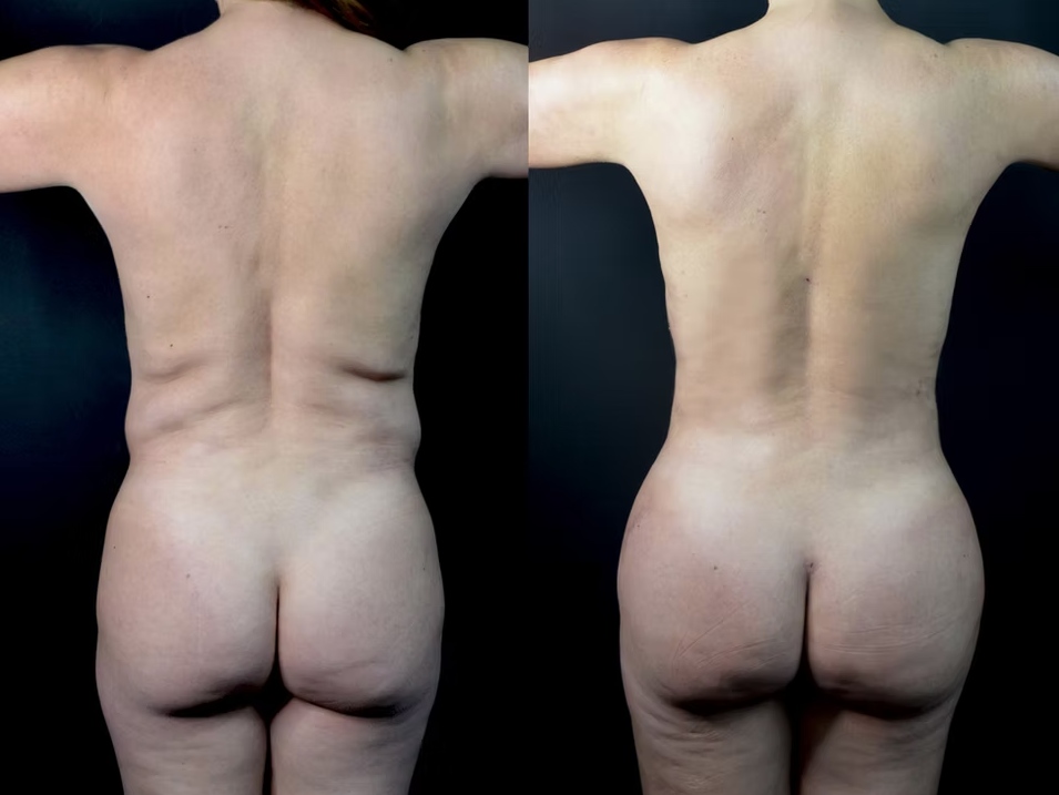 Antes / Después 5