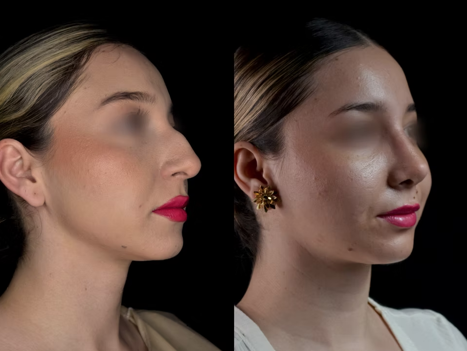 Antes / Después 1