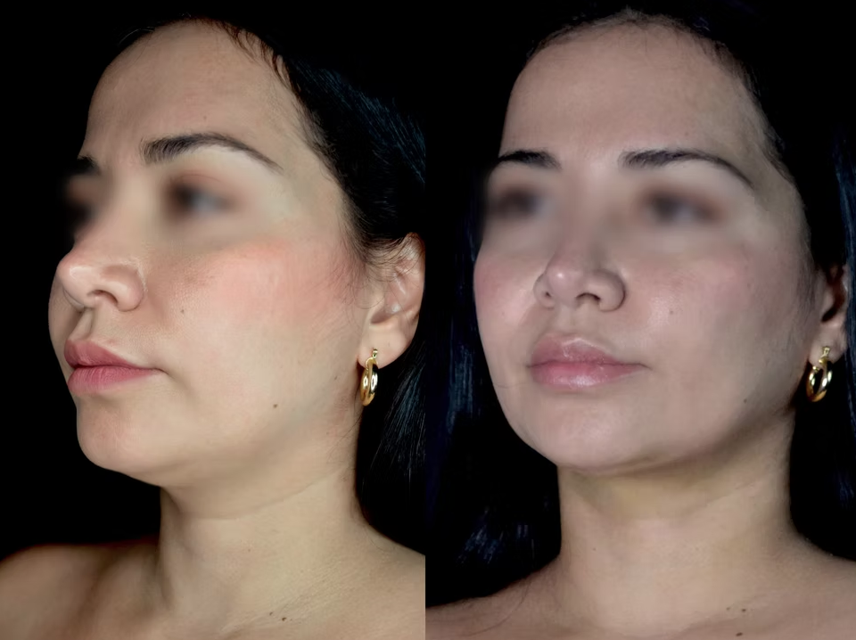Antes / Después 2