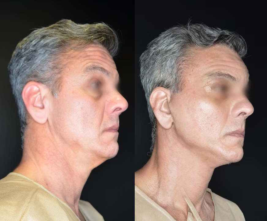 Antes / Después 2