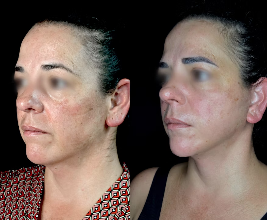 Antes / Después 1