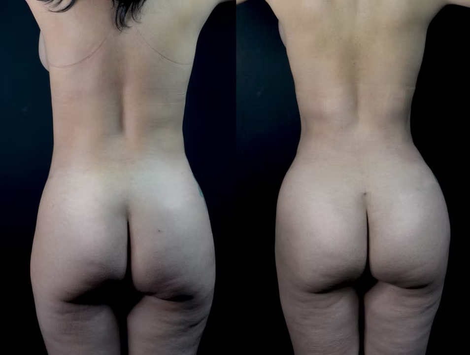 Antes / Después 7