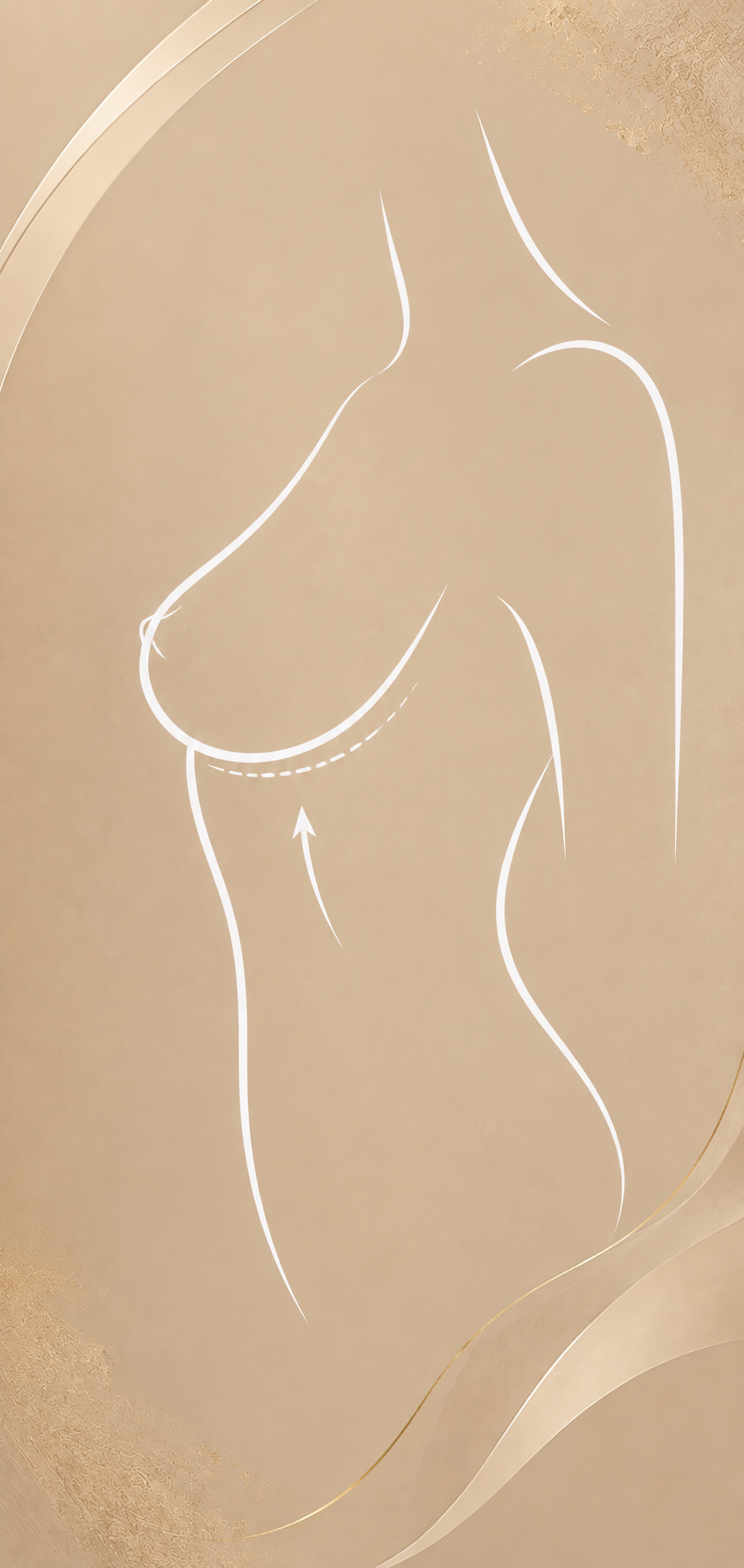 Mastopexia
