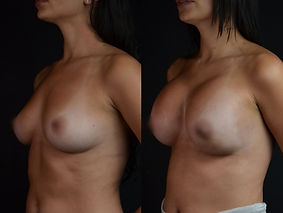 Antes / Después 2