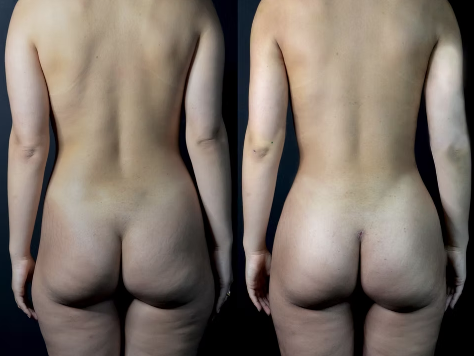 Antes / Después 3