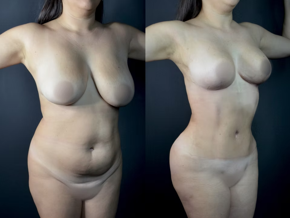 Antes / Después 5