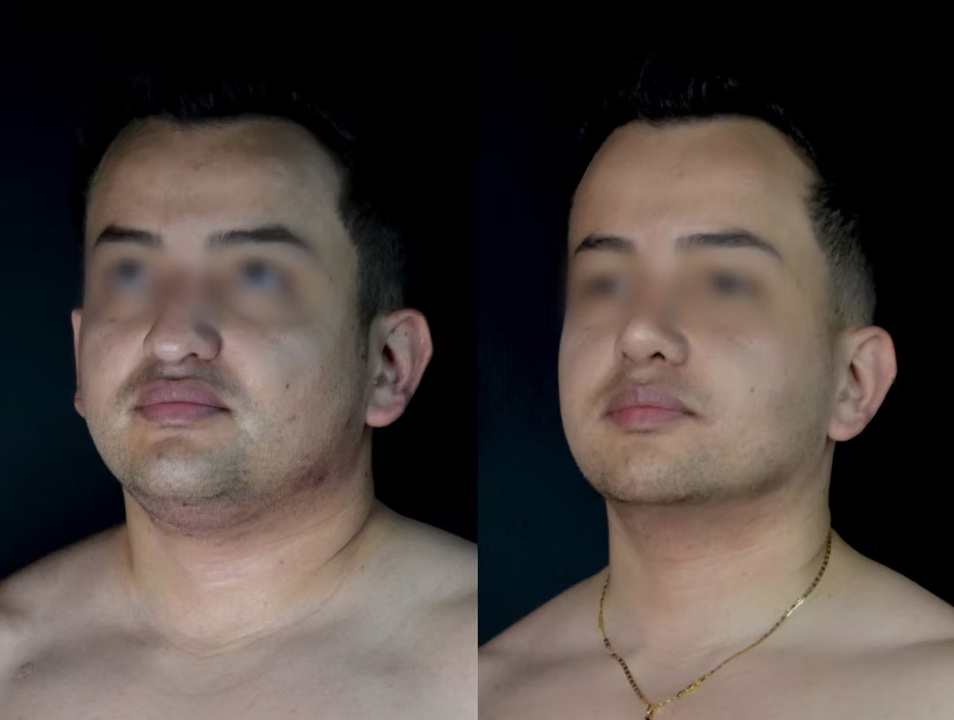 Antes / Después 4