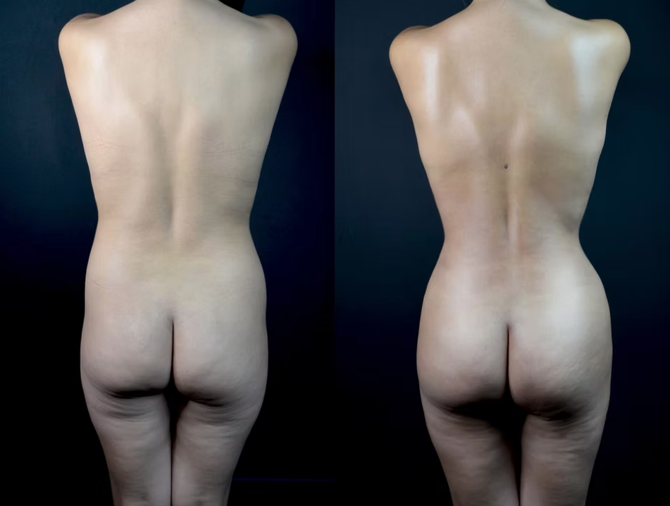 Antes / Después 2