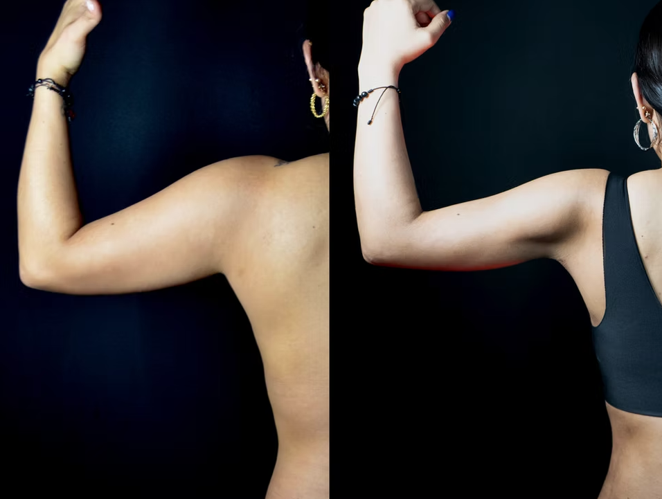 Antes / Después 5