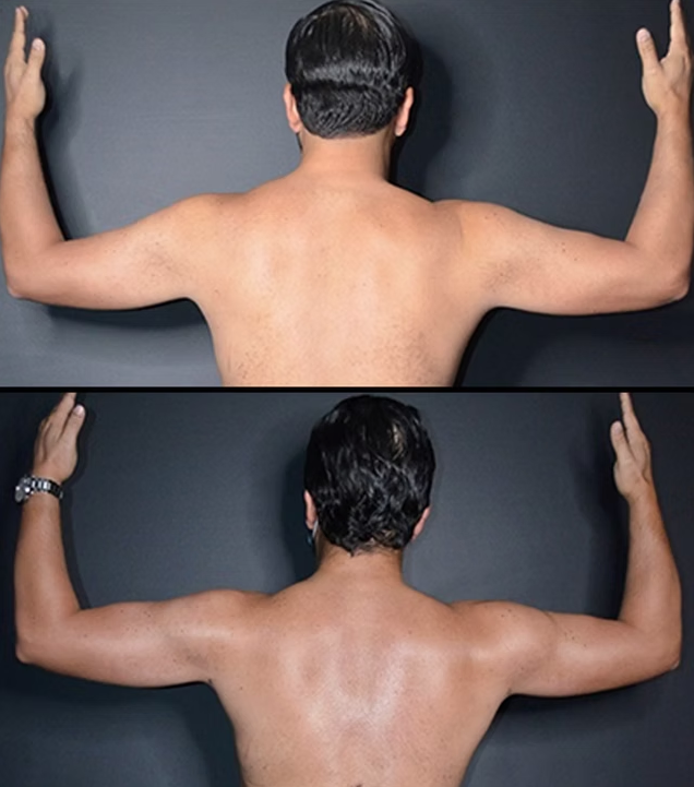 Antes / Después 6