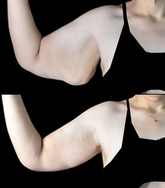 Antes / Después 5