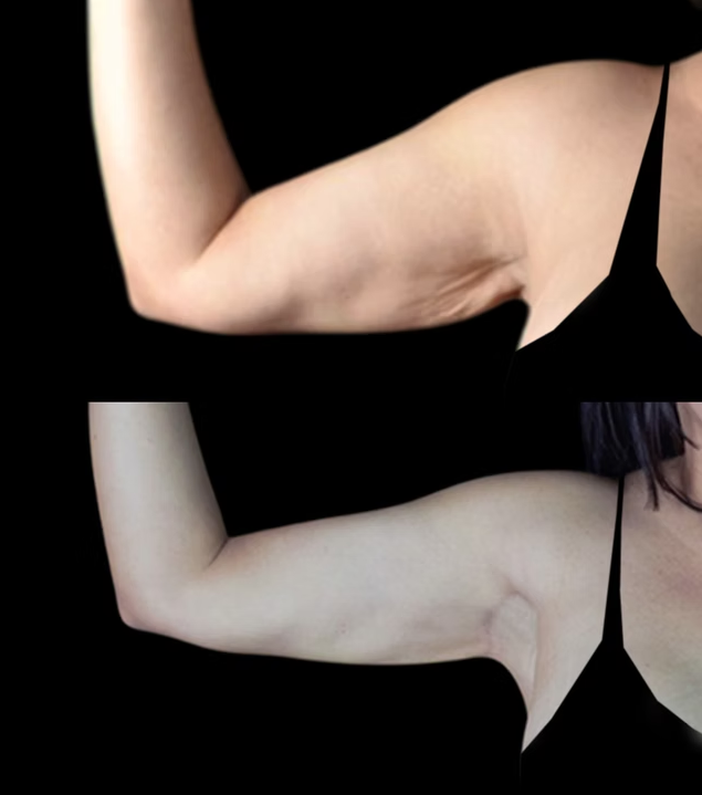 Antes / Después 3