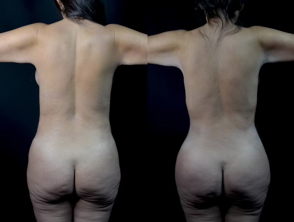 Antes / Después 2