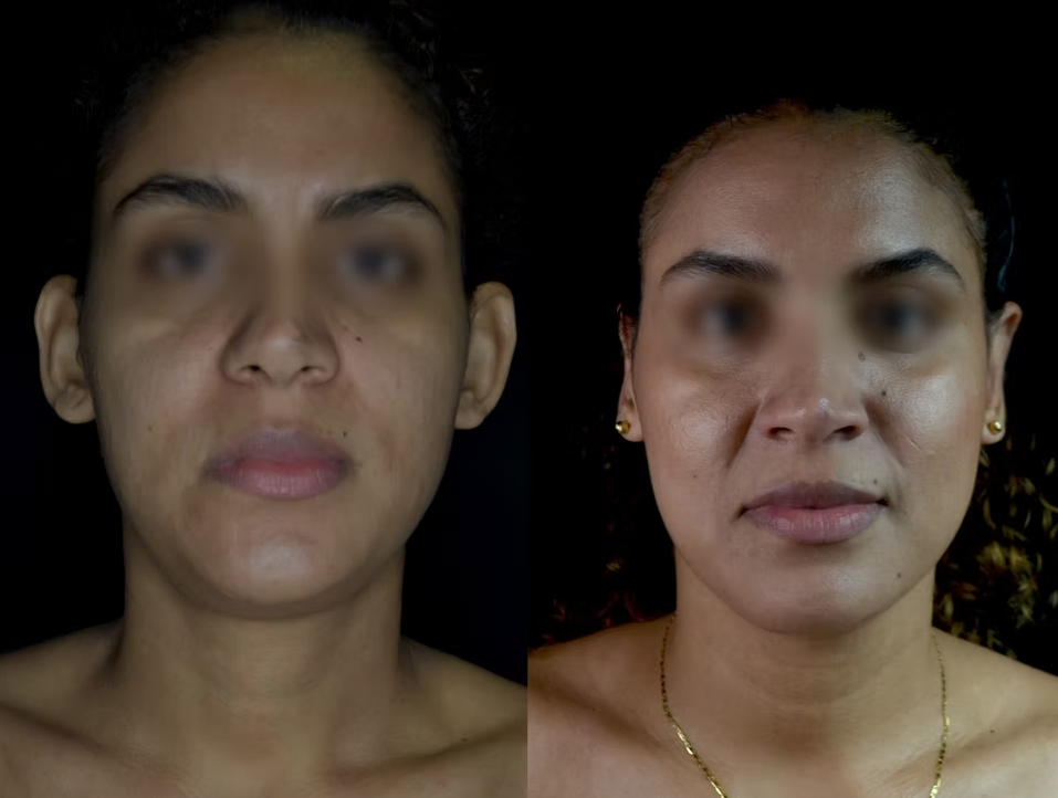 Antes / Después 1