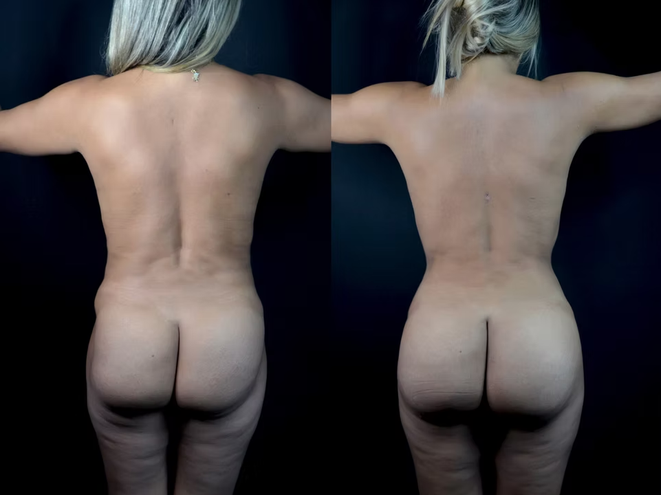 Antes / Después 6