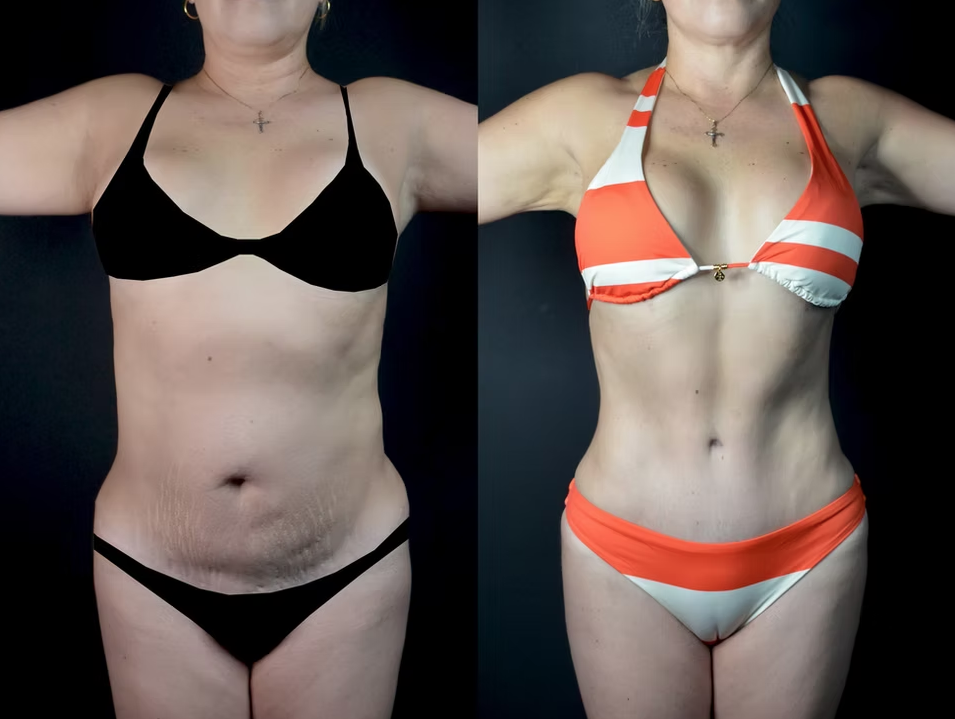 Antes / Después 3