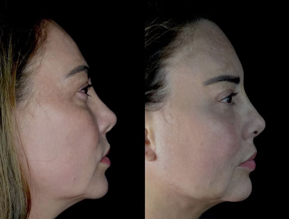 Antes / Después 1