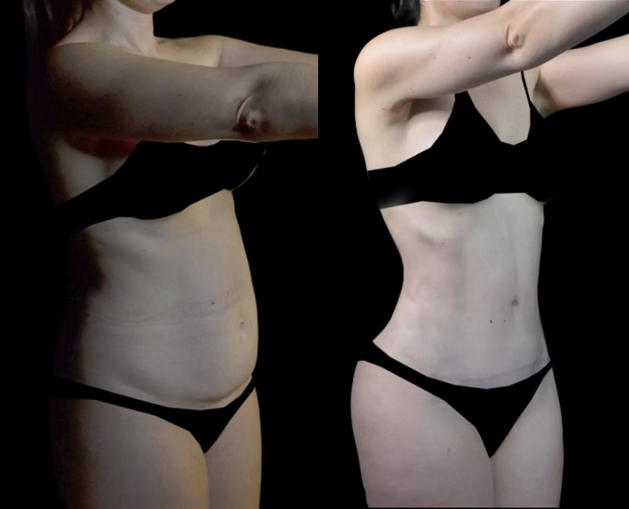 Antes / Después 1